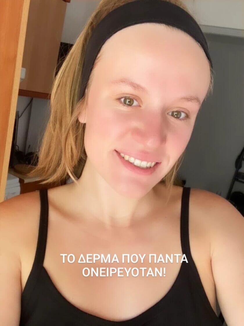 Καθαρή και λαμπερή επιδερμίδα μετά από 14 ημέρες χρήσης της φυσικής κεραλοιφής Bee Factor για ακμή και σπυράκια. Το δέρμα που πάντα ονειρευόταν — διαθέσιμο στο Eiria Cosmetics.
